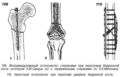 Какие суставы подлежат фиксации при переломе бедра. Накостный и интрамедуллярный остеосинтез. Накостный остеосинтез бедренной кости. Внутрикостный остеосинтез. Остеосинтез бедренной кости диафизарного.